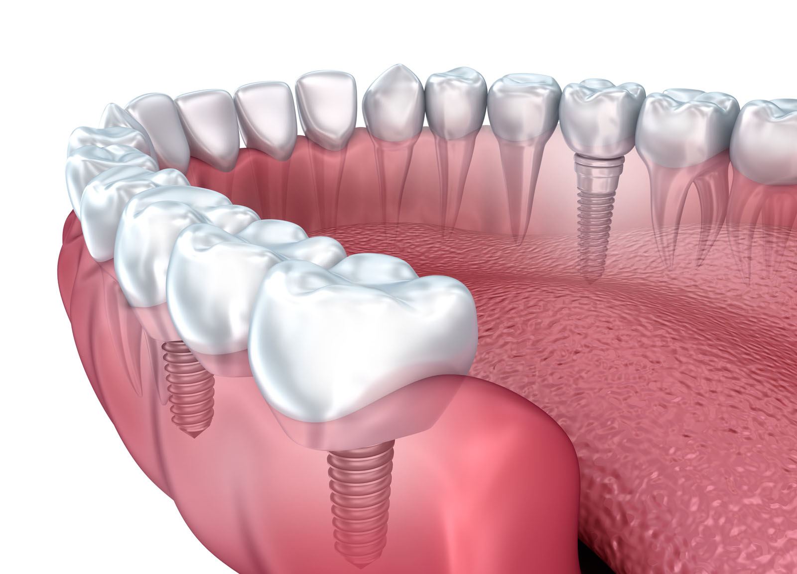 Implantes Dentales En Toluca