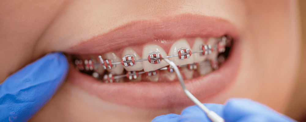 Las Fases De Ortodoncia - City Dental